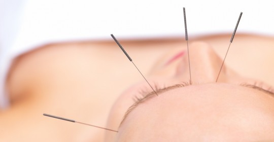 Os benefícios da acupuntura